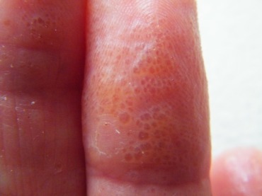 Blisters-on-blisters